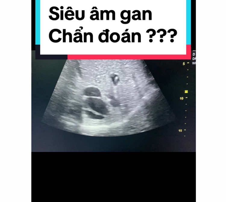 Ca lâm sàng ổ bụng số 5: Bệnh nhân nam 33 tuổi, vào viện vì vàng da, sốt, viêm gan âm tính. Chẩn đoán ??? #sieuamgan #vangda #liverultrasound 