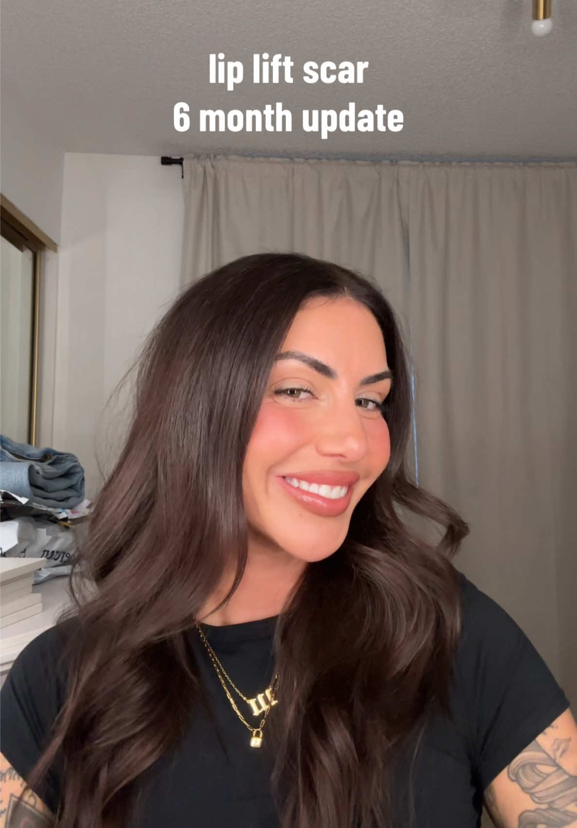 bullhorn lip lift scar update - 6 months post procedure #liplift #bullhornliplift 