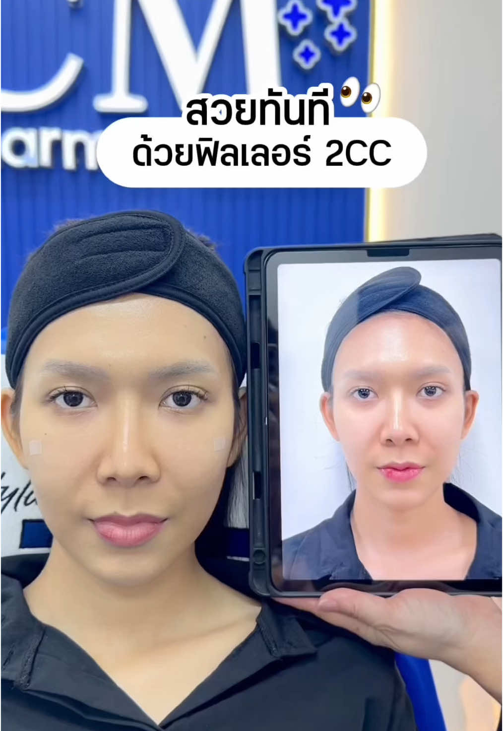 ฟิลเลอร์ 2CC ทีเดียวจบอยู่ยาวๆเป็นปี ✨ #charmerclinic #ฉีดใต้ตา #ฟิลเลอร์ใต้ตา #restylanefiller 