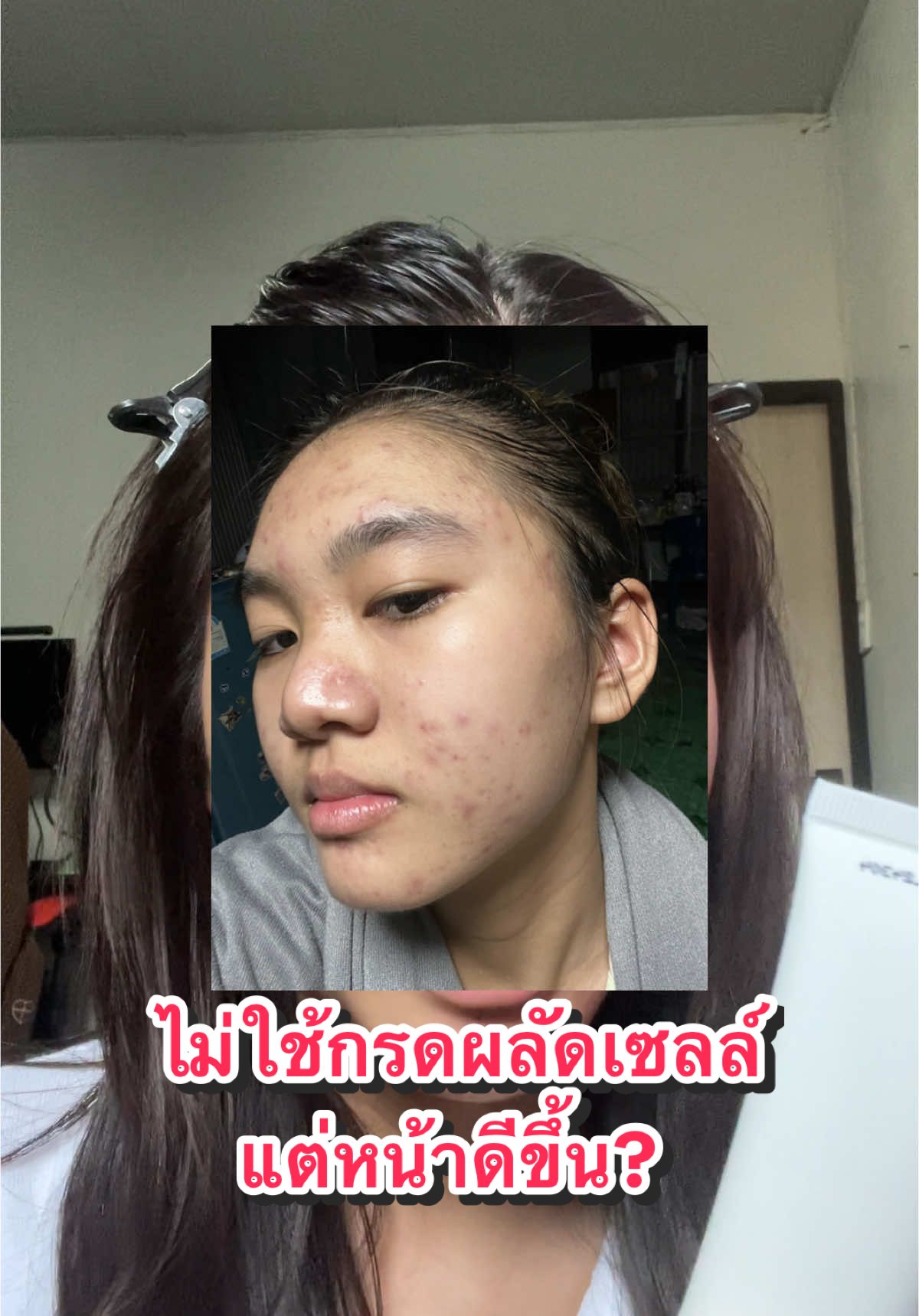 อ่ะ! ยังไงแม่ ออกวงการผลัดเซลล์ละ ไปเข้าวงการความชุ่มชื่นต่อ #ปิ๊งผิวมัน #รักษาสิว #ผลัดเซลล์ผิว 