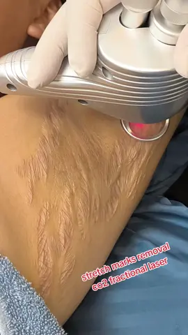 #co2laser #stretchmarkremoval #uttamchowk_pokhara #tiktok 