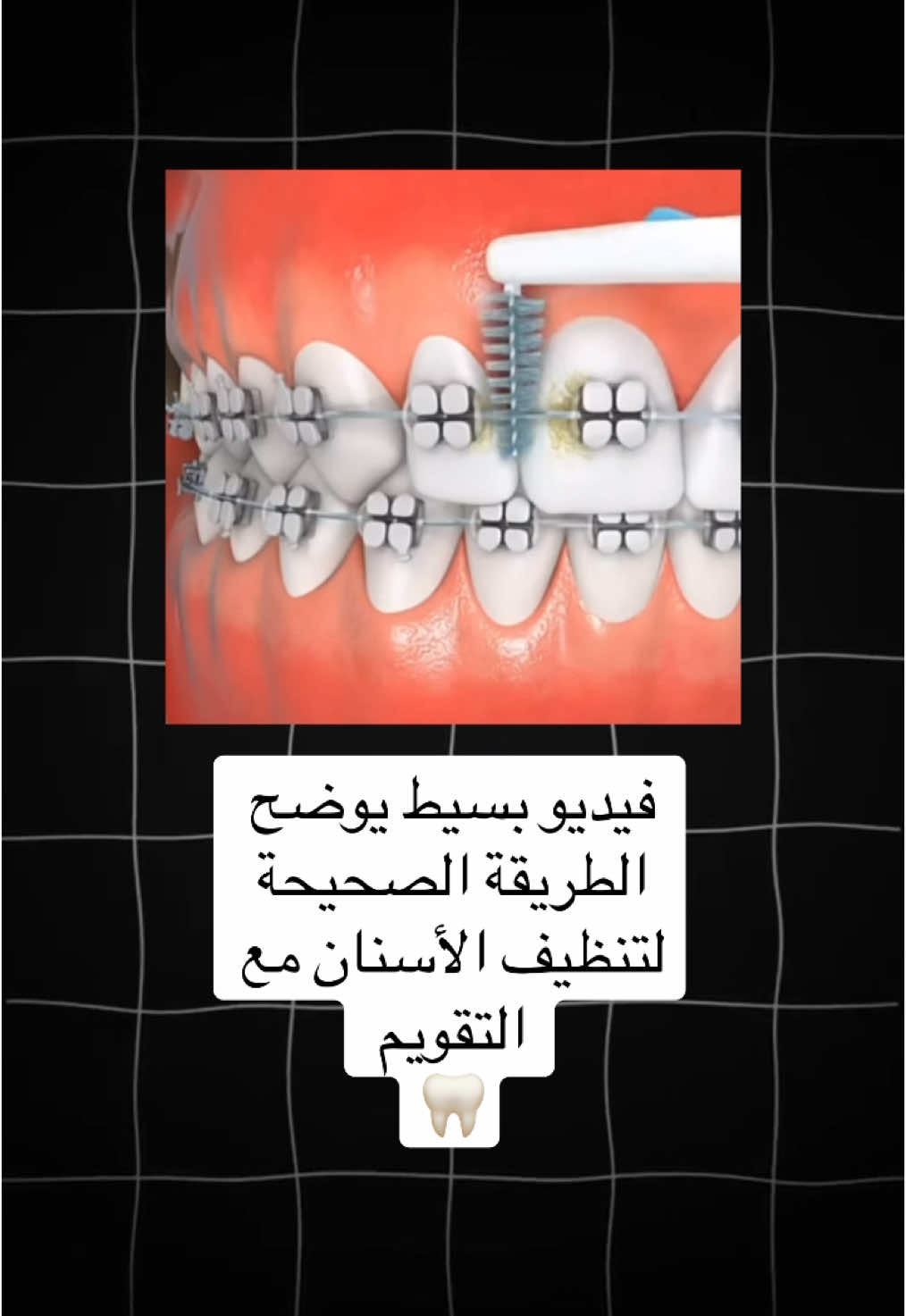 #طب_اسنان #طب_الاسنان #تقويم_الأسنان #bracestips  #تنظيف_الاسنان 