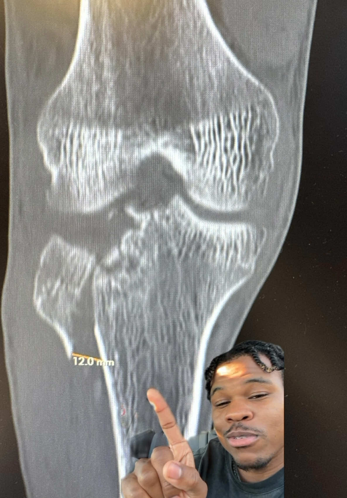 The X-ray looks more painful than it actually is🦴🩻 #gym #Fitness #workout #gymshark66