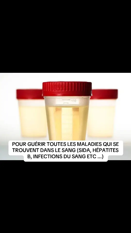 POUR GUÉRIR TOUTES LES MALADIES QUI SE TROUVENT DANS LE SANG (SIDA, HÉPATITES B, INFECTIONS DU SANG ETC ...) Si vous aviez de la foi comme un grain de séneve, vous diriez à cette montagne: Transporte-toi d'ici là, et elle se transporterait; rien ne vous serait impossible.  voici la recette :  Grain de sénevé Urine du matin de l'intéressé Chaque matin, prenez une cuillerée à café du grain de sénevé, ecrasez le bien pour le rendre en poudre fine , et ensuite l'avalez avec l'urine du matin , Huuumm, faites cela pendant 21 jours , et allez-y refaire le test , par la grâce de Dieu , vous ne verrez plus cette maladie ,  NB: le grain de sénevé se vend dans les boutiques spirituelles Pour tous vos préoccupations personnels veuillez me contacter sur mon unique numéro WhatsApp  . Que ça soit un problème de sorcellerie , problème de justice , voyage , mariage , travail peu importe le problème veuillez me contacter sur mon numéro WhatsApp qui est sur ma profil 