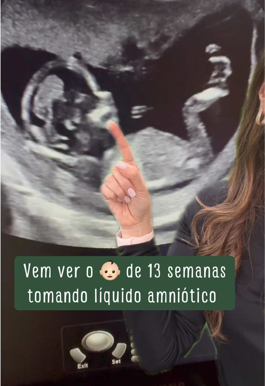 Você viu o 👶🏻 abrindo a boca, pondo a linguinha pra fora e bebendo o líquido amniótico? Obs: já viu os outros 2 vídeos no feed sobre esse tema? Dra Isabel Botelho Médica Obstetra, Ginecologista & Fetóloga CRM 150.205 - RQE 69.069 #gestante #gravida #gravidez #ultrassom #ultrassomgestacional #morfologico1trimestre #ultrassommorfologico 