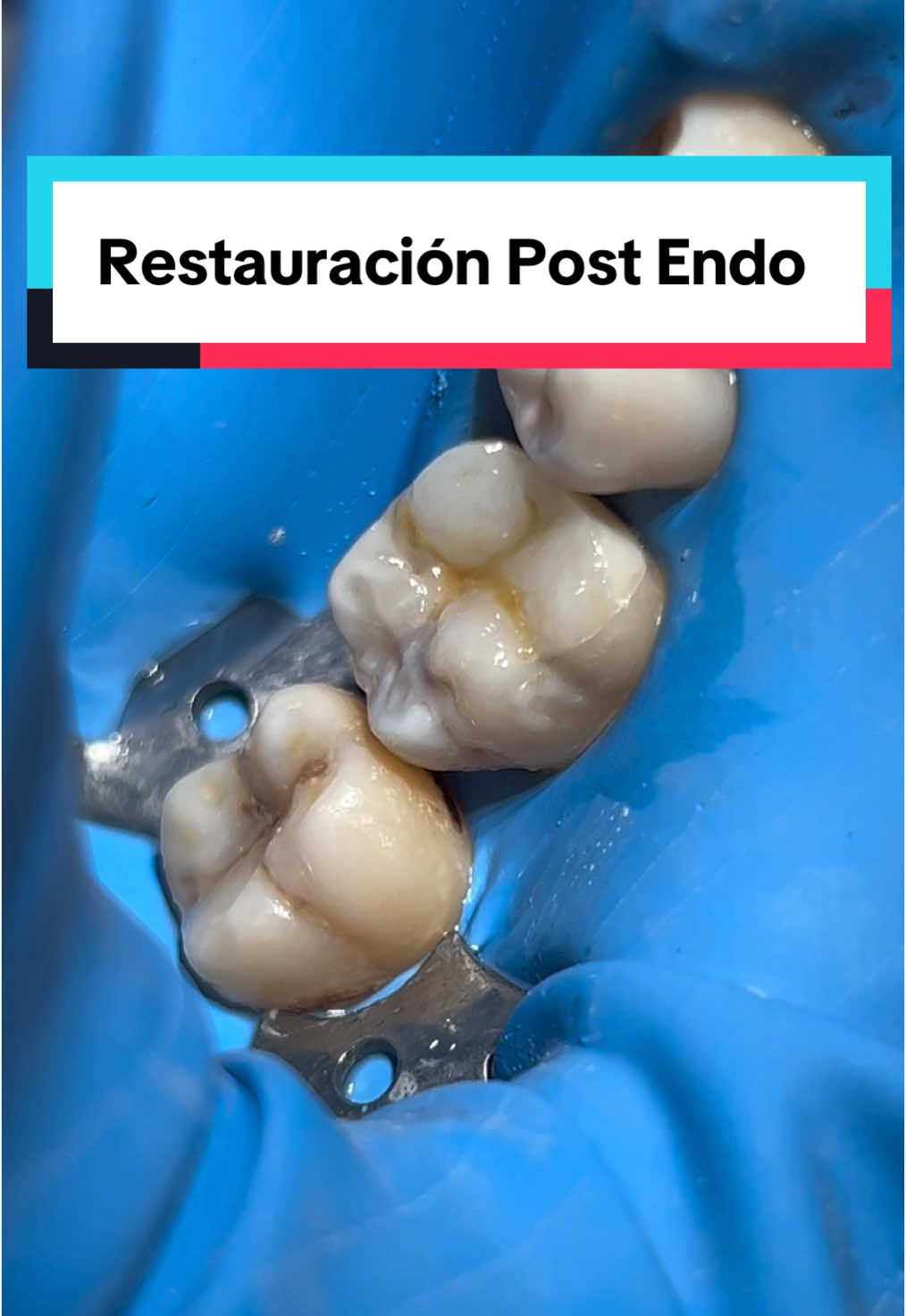 Restauración de Molar Post Endo. #resinadental #rehabilitaciondental #caries #higienebucal 