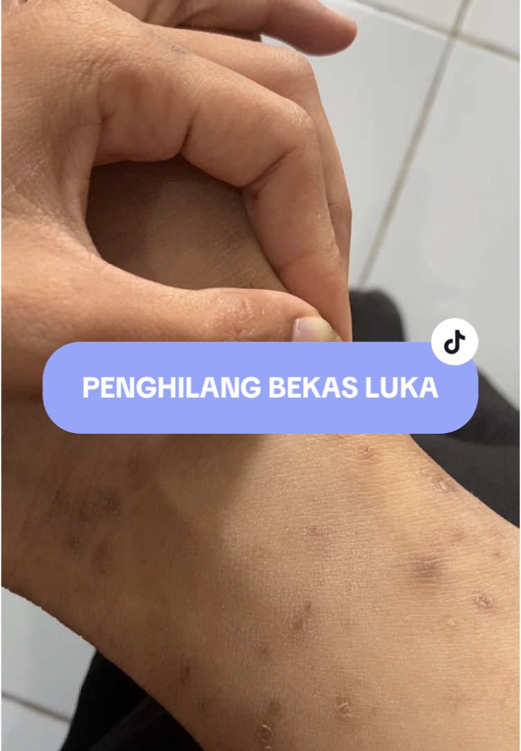 Body lotion buat ngilangin bekas luka yang gw punyaa @SHERIZ #fyp #darahmanis #GlowUp #bekasluka 