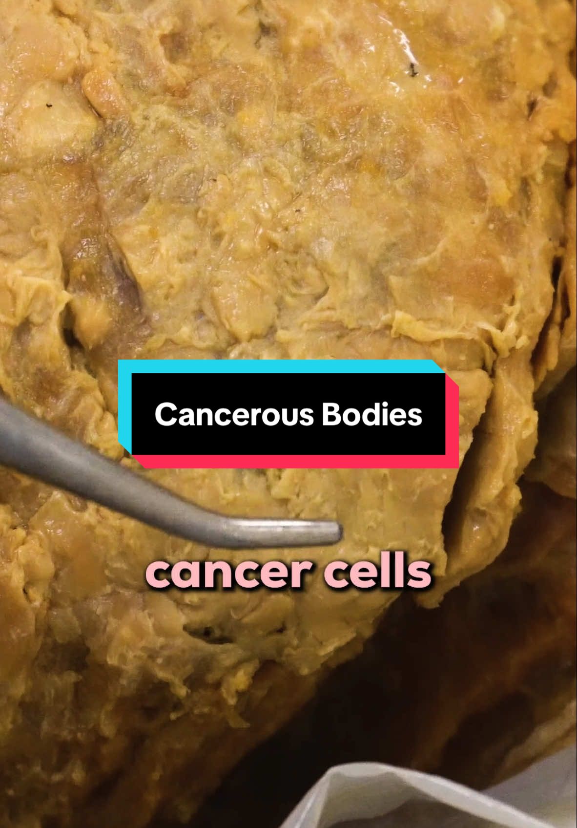 How These Bodies Died from Cancer #cancer #anatomy #science 