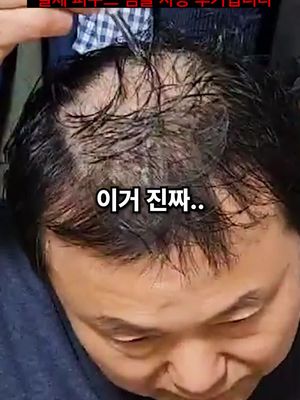 모낭세포 증식시키는 '피쿠스앰플'