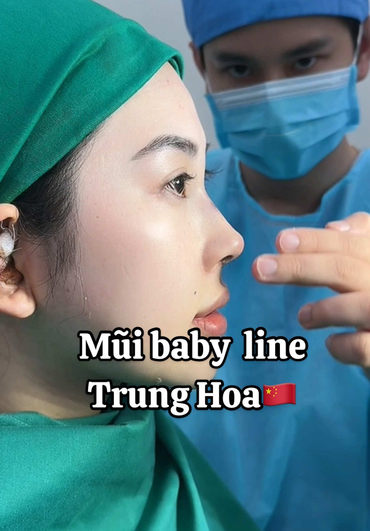 Mũi baby line Trung Hoa. #chuyensuamuihong #muitrunghoa #muiphongthuy #nangmui #lamdep #ngan98 #drthong 
