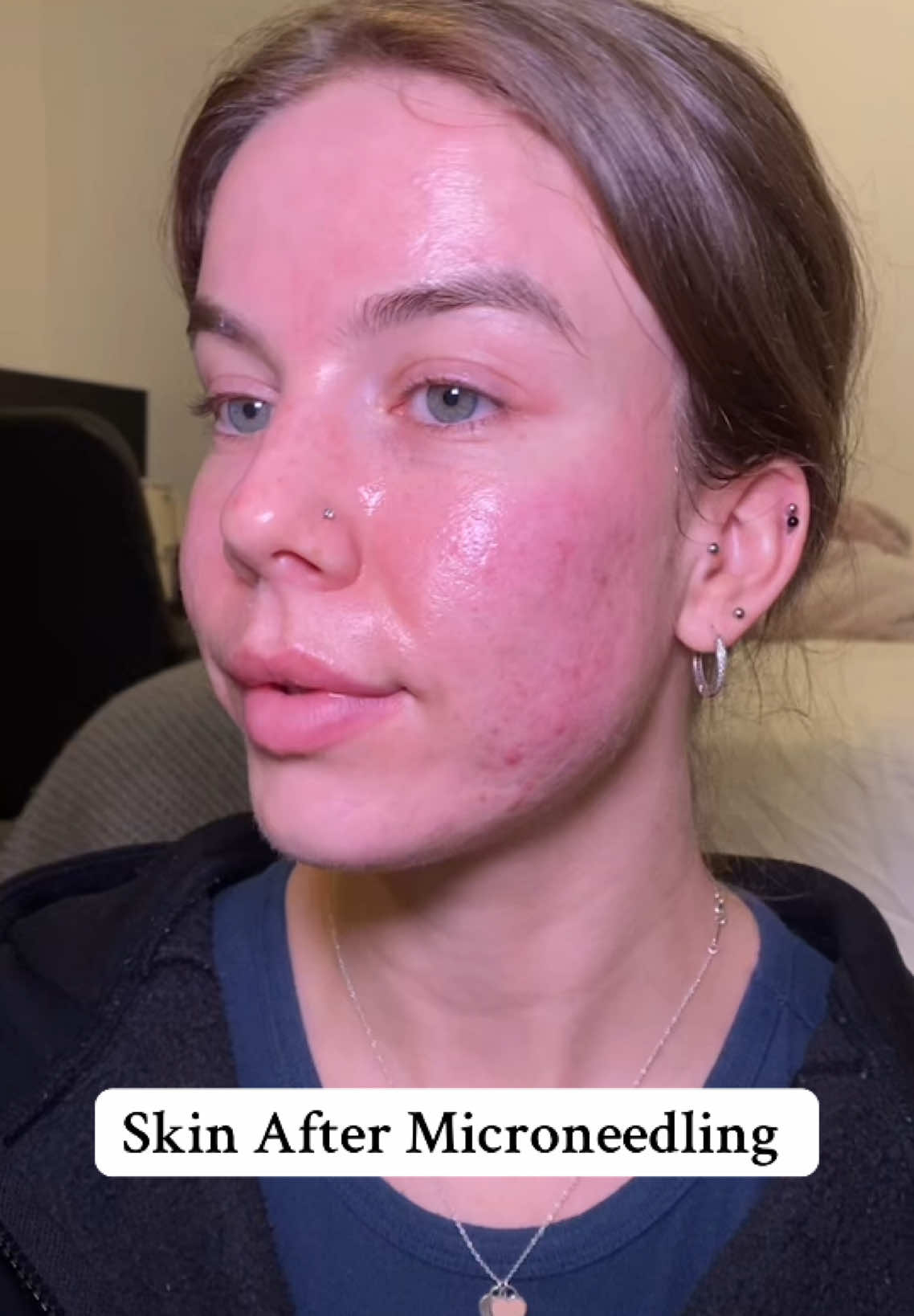 She’s very red and very shiny #microneedling #microneedlingtreatment #microneedlingafter #creatorsearchinsights 