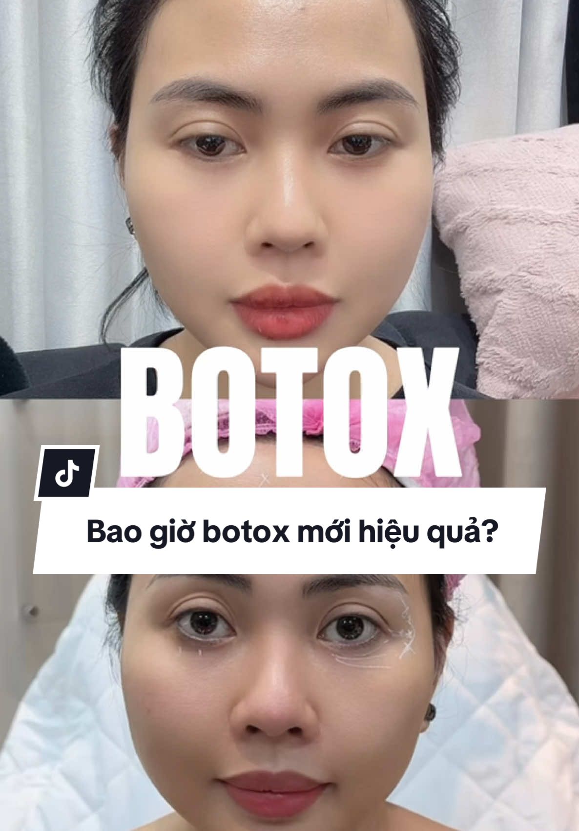 #botox bao lâu hiệu quả? #trendingtiktok #fyp #viralvideo #tiktok #trending 