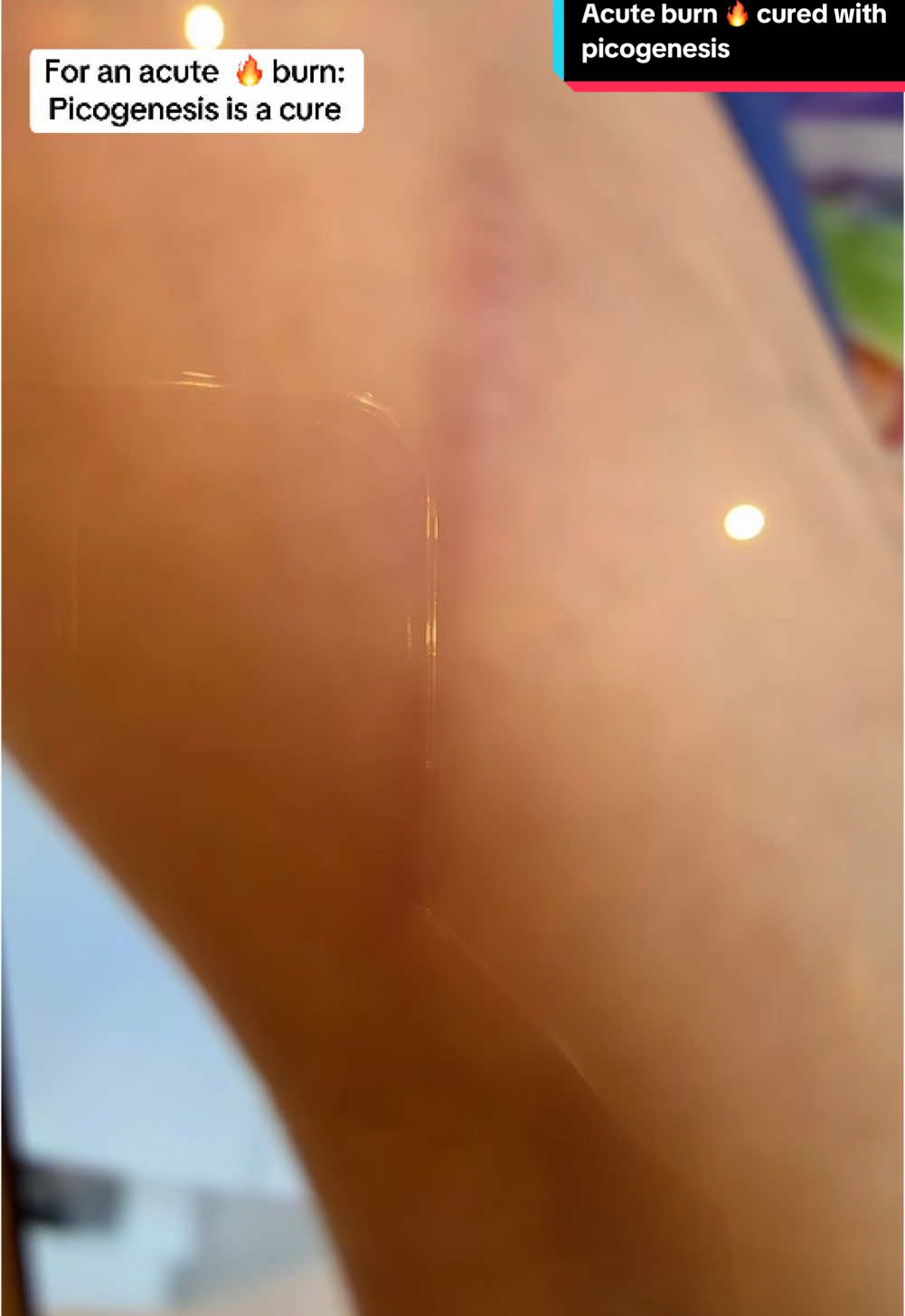 Laser#burn#scar#dermatologist#skin#fyp#foryourpage#uae#saudiarabia#qatar#bahrain#kuwait#oman#usa#uk#egypt@Dermaklinic by Dr Razan Kadry 