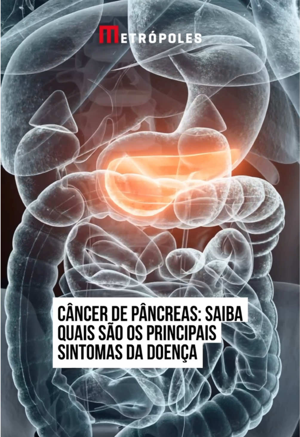 O #câncer de #pâncreas é uma doença silenciosa e agressiva. Os sintomas são frequentemente confundidos com os de outras condições e, por isso, o diagnóstico costuma ser tardio, permitindo que o quadro evolua para estágios mais graves antes de qualquer intervenção. “O câncer ocorre quando as células crescem de forma irregular e formam um tumor. Por estar localizado em um órgão de pouca sensibilidade, os sintomas geralmente se confundem com os de condições comuns, como dores no estômago ou nas costas”, explicou o oncologista Márcio Almeida, da Oncoclínicas Brasília, em entrevista anterior ao Metrópoles. A oncologista Janyara Teixeira, da Rede D’Or, em Brasília, acrescenta que a doença é altamente agressiva e apresenta alta taxa de mortalidade. “Na maioria dos casos, o câncer de pâncreas cresce para fora do órgão, o que torna a cirurgia de remoção um procedimento complexo”, destacou a médica em em entrevista anterior ao Metrópoles. Embora o tumor geralmente não cause sintomas perceptíveis nos estágios iniciais da doença, pequenas mudanças no corpo podem surgir à medida que ele progride. Confira cinco sintomas que podem indicar a presença do câncer. 1 – Icterícia A icterícia é caracterizada pelo tom amarelado nos olhos e na pele, causado pelo acúmulo de bilirrubina no corpo. Essa substância, de cor amarelo-escura, é produzida no fígado e está envolvida no processo de quebra de gorduras. 2 – Perda de apetite e peso A perda de peso e do apetite em pacientes com câncer de pâncreas está associada ao estado inflamatório do órgão. Segundo Janyara, o processo inflamatório faz com que o organismo libere proteínas como a interleucina e o interferon, que inibem a vontade de comer. #tiktoknotícias 