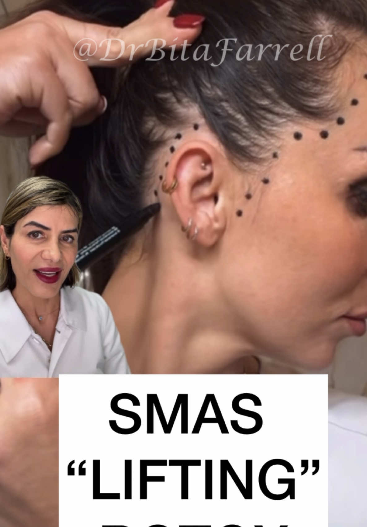 Don’t believe the hype… #smasbotox #smas #botox #botoxtraining #drbitafarrell #naturalaestheticscenter 