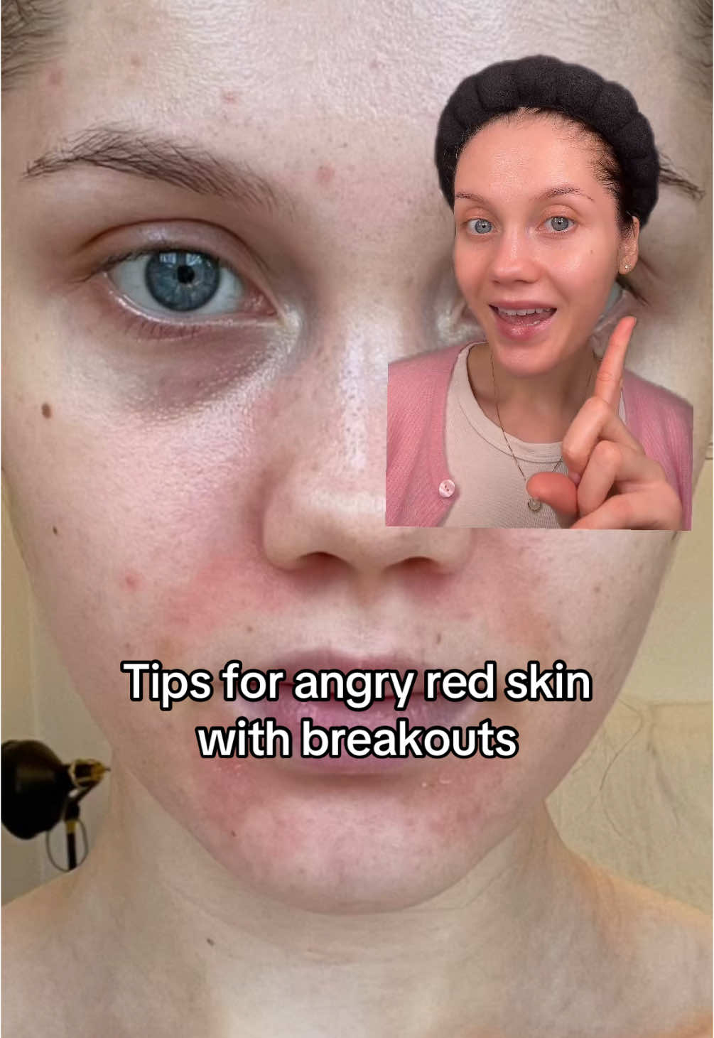 Tips for angry red skin with breakouts‼️💔 @haruharu wonder unscented deep cleansing oil @Murad Skincare soothing oat and peptide cleanser @PURITO SEOUL unscented centella serum @[coat]s triple water moisture cream @Avene UKI cicalfate+ cream @skinaquaid uv super moisture essence #dermatitis #breakouts #acnetips #skincaretips #skincareroutine #acne #acneroutine #skincare #damagedskinbarrier #skinbarrierrepair 