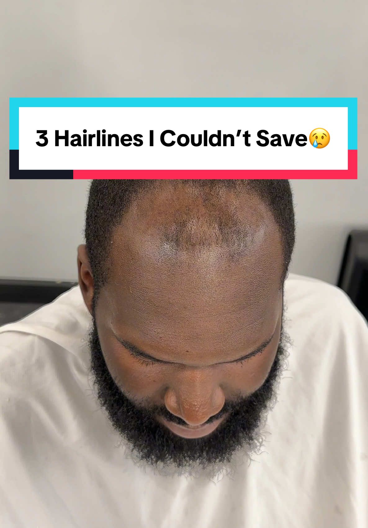 3 Hairlines I Couldn’t Save 😢 Explore the struggles with hairline challenges in ‘3 Hairlines I Couldn’t Save.’ From hairlines receding to difficult hairline edges, the article compares line up vs natural hairline techniques, including hairline line up and hairline taper methods. It also covers square hairline and hair lines design strategies for a tapered hairline big forehead, emphasizing challenges with maintaining precise hairline styles.  #Krispykats #phillybarber #phillyhaircut #hairline #recedinghairline #thinninghair #fringe 