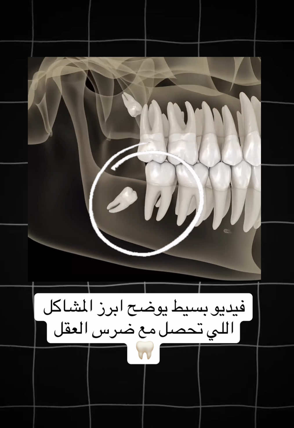 #طب_اسنان #طب_الاسنان #ضرس_العقل #ضرس_عقل #خلع_ضرس_العقل #خلع_ضرس_العقل_المطمور 