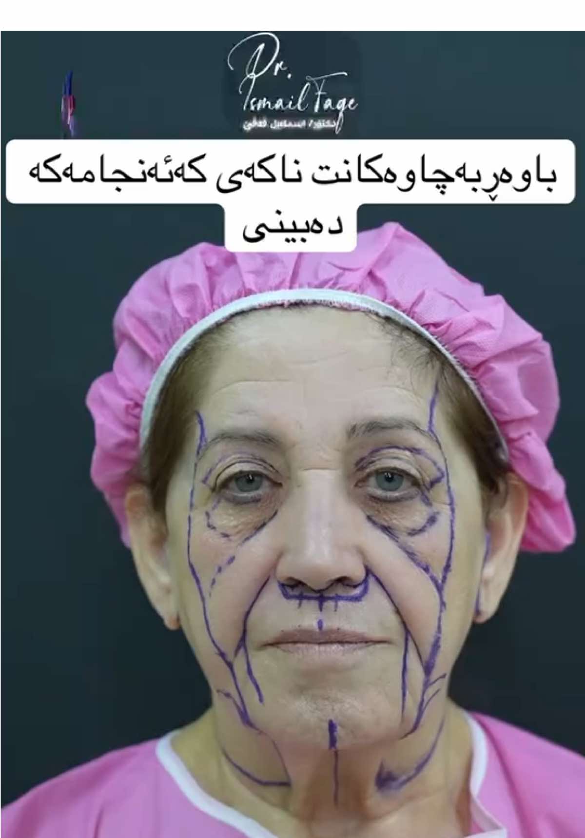 #facelift #شد_الوجه #شدالاجفان #شدالرقبة #رياض #اربيل #بغداد #سليماني #دهوک #دهوک 