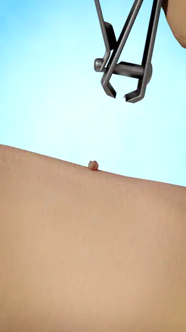 Removing Skin Tags With Nail Clippers 😮
