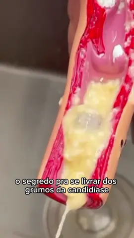 Se você já se viu cheia de grumos e aflita porque a pomada não está resolvendo , essa técnica vai te dá um alívio imediato dos sintomas  Mas atenção, não faça ela se seu pH estiver acima de 4,5 ou pode causar mau cheiro no canal v4ginal .  Mas se quiser aprender a tratar candidíase a mau cheiro íntimo usando erva e óleo medicinais , digita , entra no link da Bio e se inscreva no meu grupo VIP 