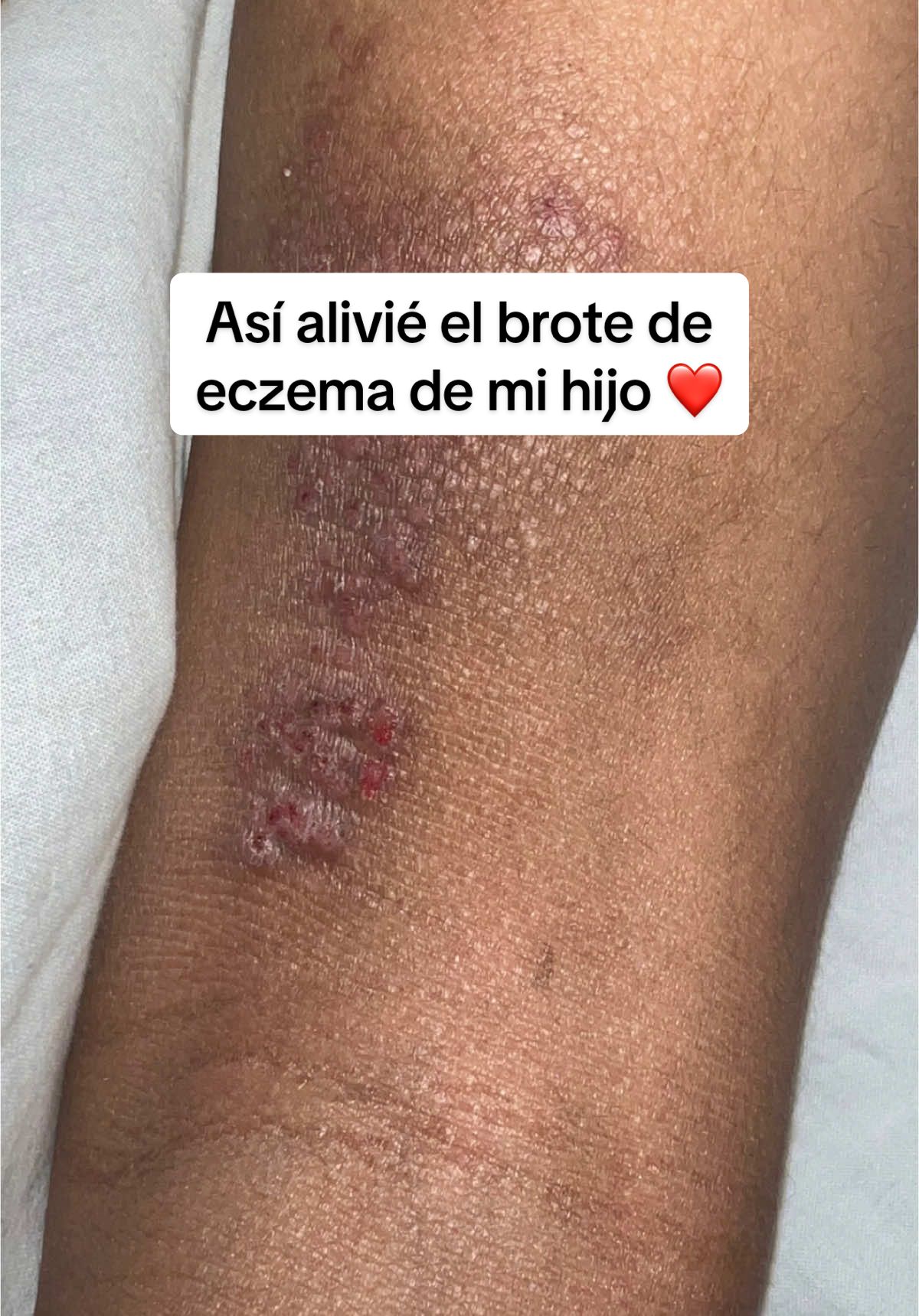 Cuando mi hijo tuvo último brote de dermatitis, fue un golpe duro para mí, pero afortunadamente yo sabía qué hacer, sabía que me había descuidado un poco con su comida, así que tuve que ponerme casi inflexible por una semanas y cuidar su piel con productos seguros 🙏🏽❤️. Los resultados de las pruebas que le hice salieron con leaky gut, por eso mi enfoque fue específicamente en su alimentación, probióticos y prebióticos recetados por su naturópata 🫶🏽 Con paciencia su piel empezó a calmarse y en el video pueden ver el resultado final 👏🏽 ‼️Nuestros productos son sin esteroides, funcionan para cualquier tipo de eczema. Hacemos envíos a Puerto Rico, Estados Unidos, Canadá y Reino Unido ✈️ #dermatitisatopica #dermatitisatópica #pielatopica #dermatitisatopik #eczemaskincare #eczema #pielessensibles #USA #estadosunidos #dermatitis 