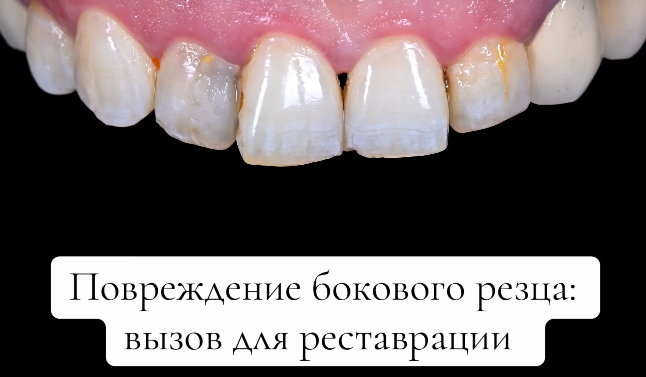 Именно с такой жалобой обратилась ко мне данная пациентка. Всё верно, зуб на первой фотографии был запломбирован ровно 2 недели назад. Со слов пациентки, она обратилась в случайную клинику, где ей согласились быстро пролечить зуб. В итоге она осталась недовольна результатом. После проведения диагностики, по желанию пациентки, было решено сделать временную реставрацию на боковом резце. Наши действия: 	1.	Сделали фотопротокол. 	2.	Убрали старую пломбу. 	3.	Очистили кариес под пломбой. 	4.	Обработали поверхность и провели адгезию. 	5.	Сделали временную реставрацию. 	6.	Выполнили финишную полировку и повторный фотопротокол. #лечениезубов #кариес #реставрациязубов #виниры #алматы #стоматология #restoration #teethwhitening #teeth #endodoncia #treatment #rootcanal #обтурация #удалениезуба  #зубмудрости #фронт