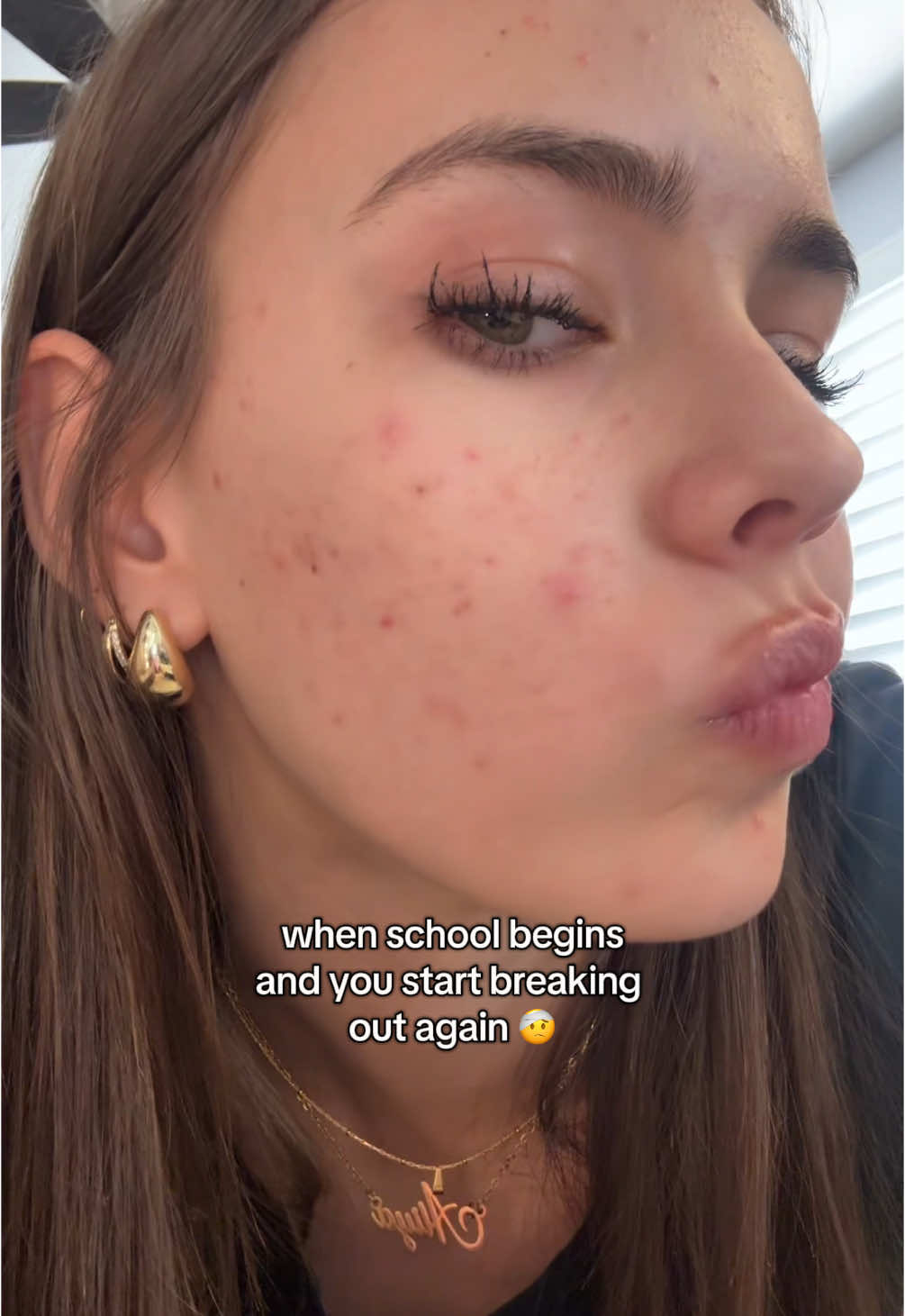 anyone else? #relatable #school #acne #skinfyp 