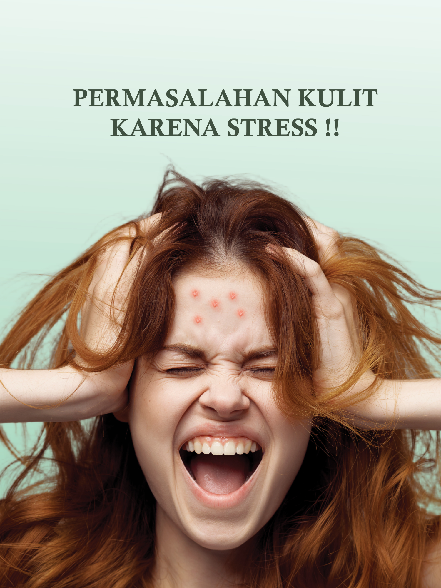 Akibat stress berlebihan muncuk masalah kulit ini loh 🥹 #stress #kulitkusam #kulitsehat #masalahkulit #rekomendasi #naturalskincare #miels #fyp #trending