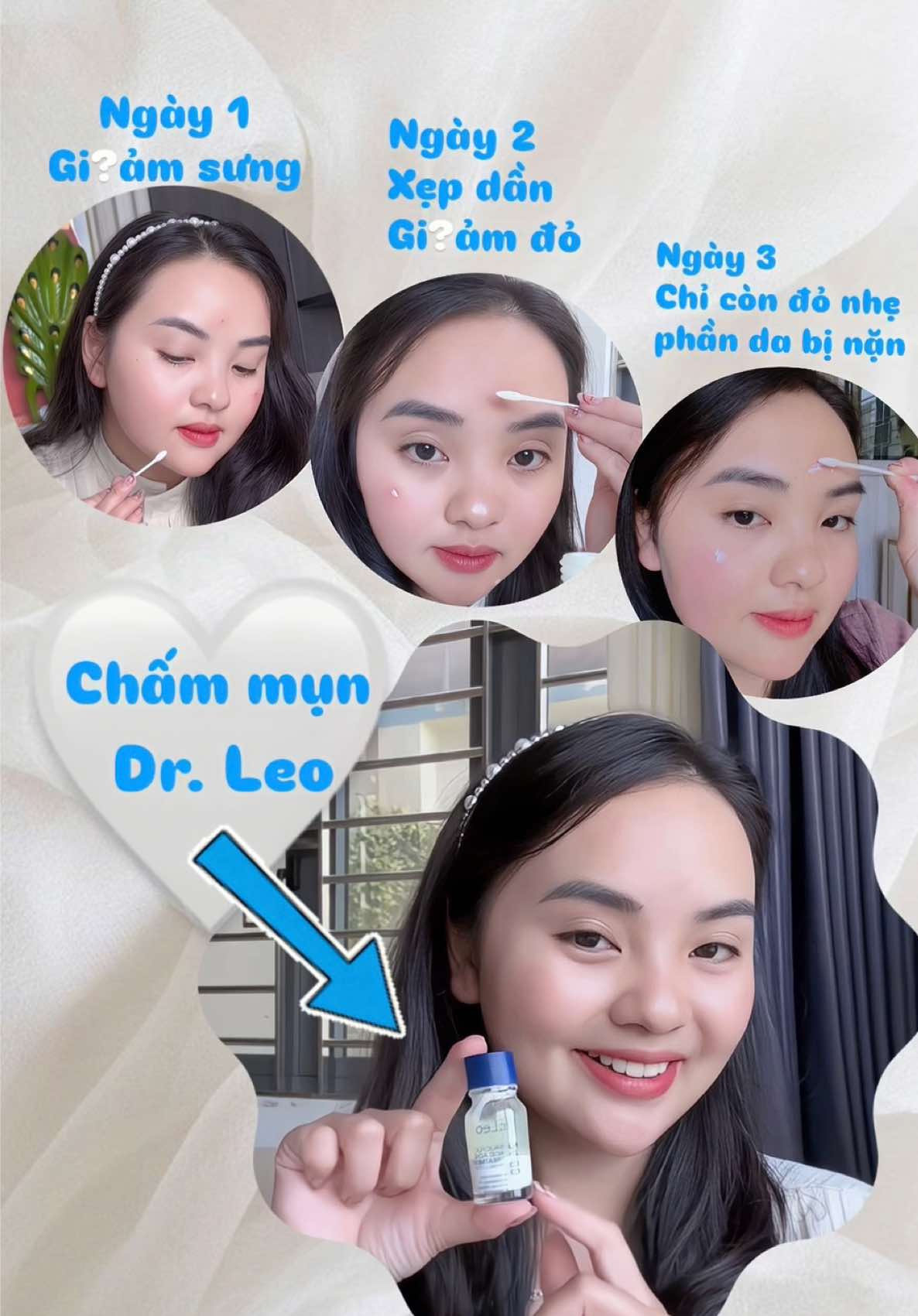 Tết đến nơi rồi còn bị mụn, đừng nặn nha, dùng châm mụn Dr.Leo này đi, mụn nhanh xẹp lại không bị thâm da sau mụn nữa đó #chammun #chammundrleo #drleo #drleoVN #acne #AcneBuster #AcneSolution #acnetreatment #skincare #fyp #pimple#giadinhtayrot #tayrotfamily #damun #mun #munviem #munsungviem #munnoitiet #munboc 