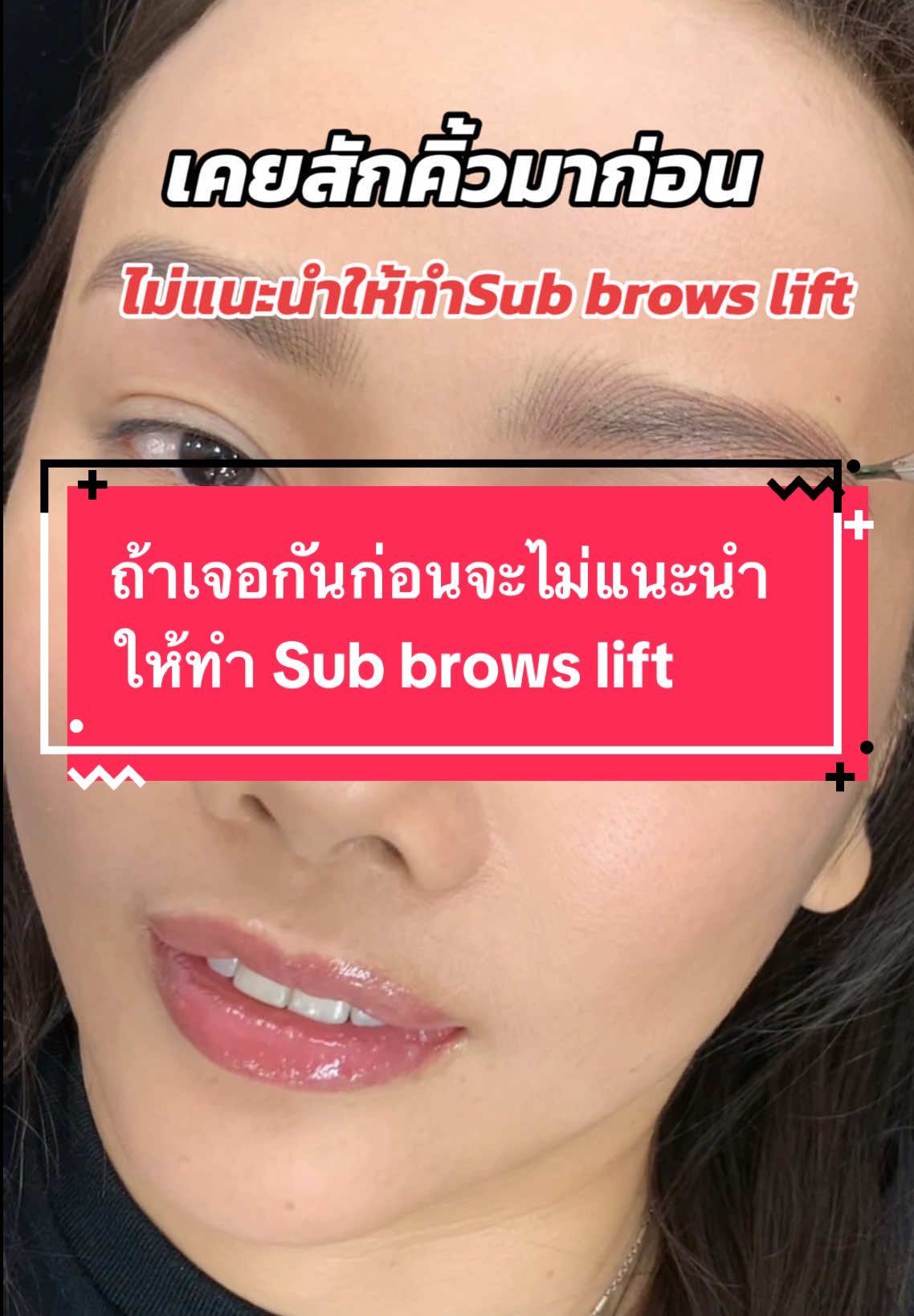 ทำsub brows lift ดีไหม #แก้คิ้วเชียงราย #สักคิ้วเชียงราย #อาจารย์เต๋าสักคิ้วเชียงราย #subbrowlift #สักทับรอยแผลเป็นจากการเย็บยกคิ้ว #ร้านสักคิ้วเชียงราย #สักคิ้วลายเส้นธรรมชาติเชียงราย #มีรอยแผลเป็นที่คิ้วสักทับได้ไหม #แก้คิ้วลบคิ้วเชียงราย #สักแก้ไขรอยแผลเป็น #ที่สักคิ้วเชียงราย #สักคิ้วเชียงรายสวยๆ #สักคิ้วผู้ชายเชียงราย 