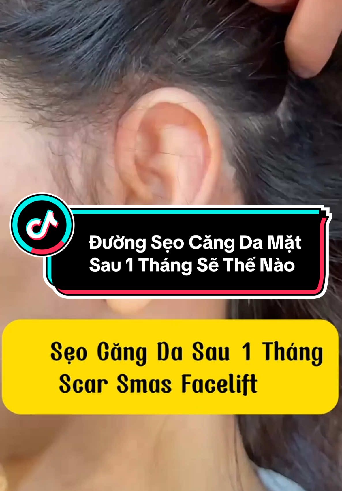 Sẹo Căng Da Mặt Sau 1 Tháng Sẽ Thế Nào #xuhuong #trending #smasfacelift #pttm #drlongck1pttm #căng_da_mặt #căng_da_mặt_toàn_phần 