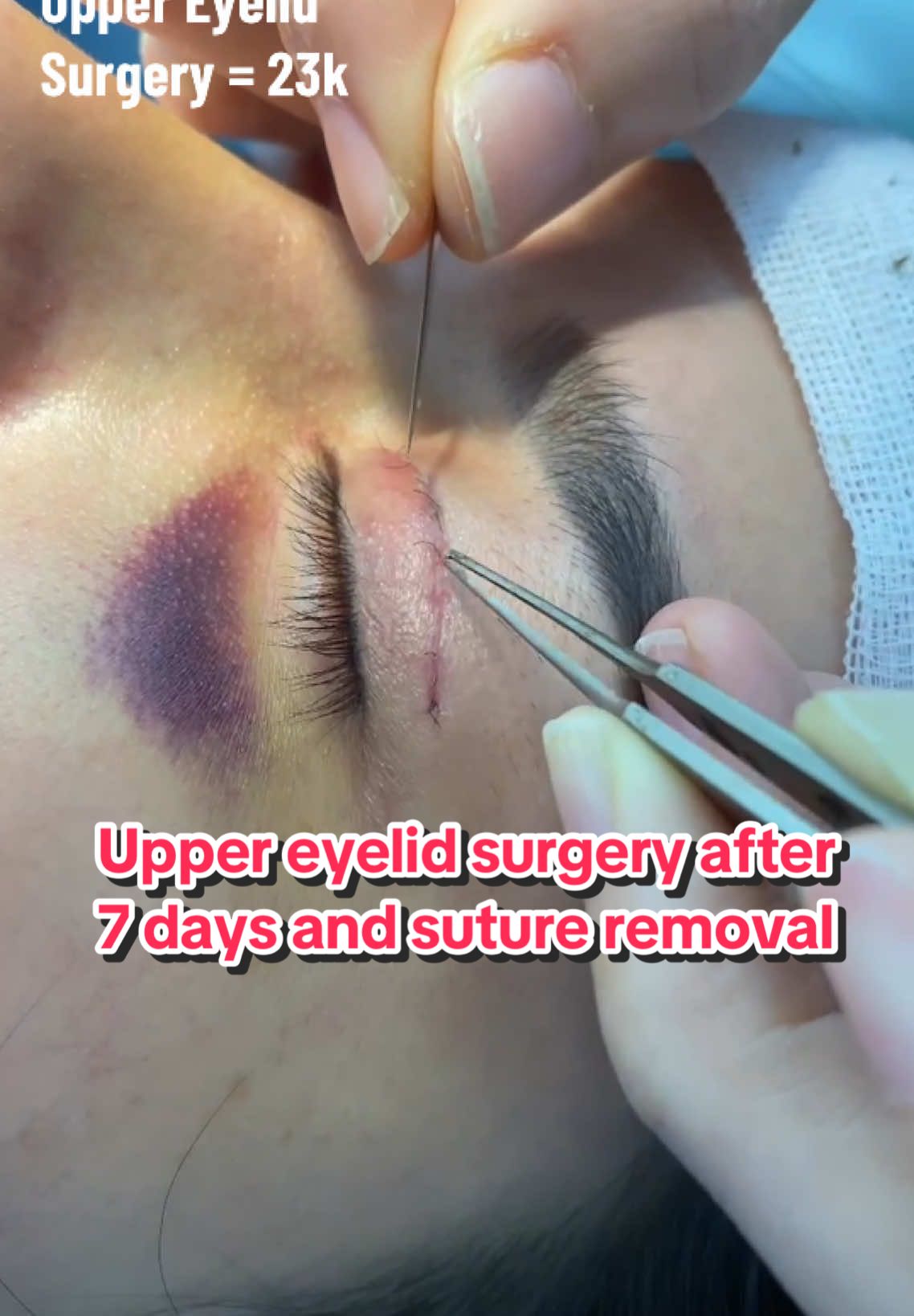 Upper eyelid surgery after 7 days and suture removal #fy #fyp #eyelid #surgery #views #dryang 