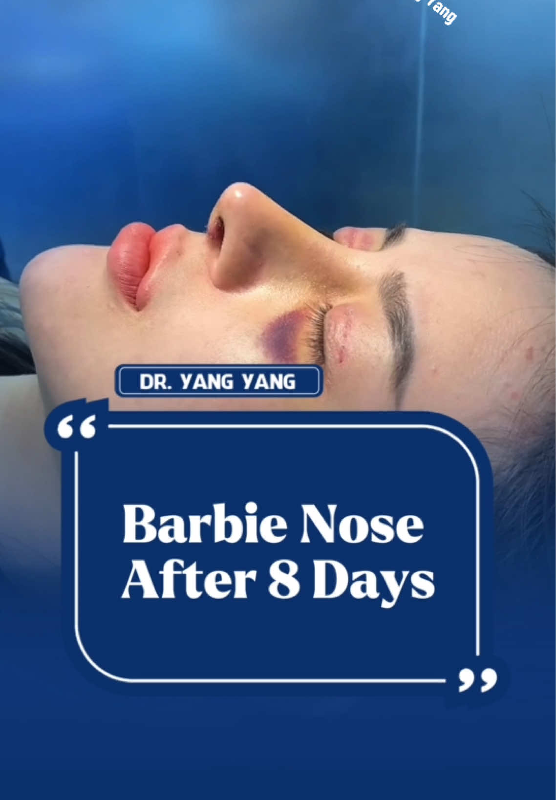 Part 147 : Barbie Nose After 8 Days #goretex #rhinoplasty #fy #fyp #surgery #views #dryang 