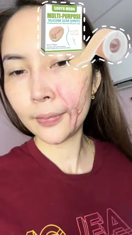 ลดรอยแผลเป็นบนผิวหนัง ต้องใช้ต่อเนื่องยาวนาน#facetape #facetaping #facetapingtutorial