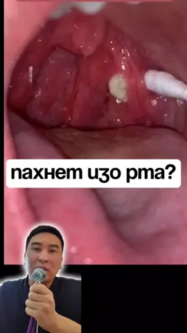 Привет, друзья! Сегодня поговорим о миндалевых пробках – маленькой, но неприятной проблеме, которая может портить вам настроение и свежесть дыхания. Что такое миндалевые пробки? Миндалины – это часть нашей иммунной системы. Они защищают нас от бактерий и вирусов. Но иногда в их углублениях могут скапливаться остатки пищи, мертвые клетки и бактерии, образуя миндалевые пробки. Эти маленькие белые или желтые комочки могут стать причиной неприятного запаха изо рта. Почему появляется неприятный запах? Когда миндалевые пробки разлагаются, они выделяют сернистые соединения, которые и являются источником неприятного запаха. 😷 Это может быть особенно заметно, если вы чувствуете, что даже после чистки зубов запах остается. Что делать? Гигиена полости рта: Регулярно чистите зубы и язык, используйте зубную нить и ополаскиватель для рта. Это помогает уменьшить количество бактерий. Полоскание: Полоскание теплой соленой водой может помочь убрать пробки и предотвратить их появление. Регулярные визиты к ЛОРу: Если проблема становится частой, лучше обратиться к специалисту. Иногда требуется профессиональное удаление пробок. Увлажнение: Пейте больше воды и избегайте пересыхания горла, особенно если вы часто дышите ртом. 💧 #tonsillitis #tonsil #ангина #лор #дети #otolaryngologist 
