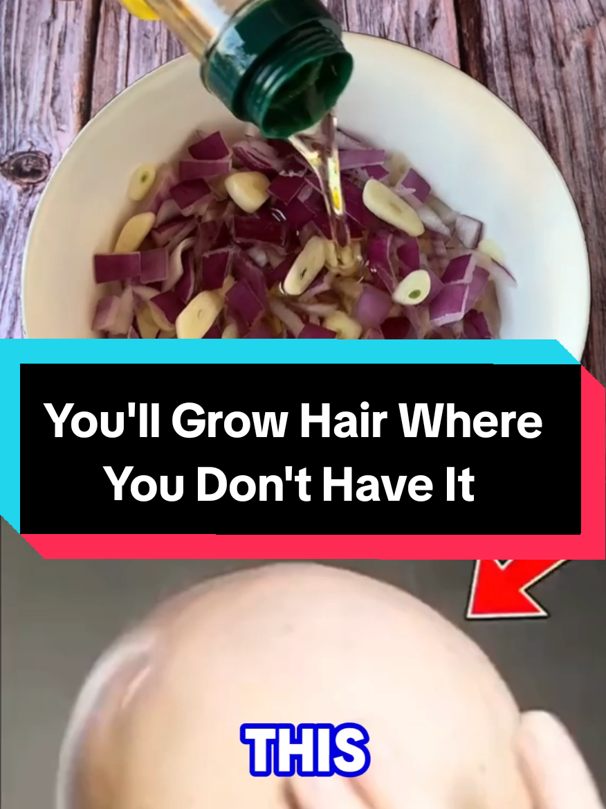 This will grow #hair where you don't have it. #hairgrowth #growhair #hairloss #remedy  #haircareroutine #haircare #Recipe  Don't use too much because it will grow too much. #naturalremedy #naturalremedies #recipes #naturalrecipes 