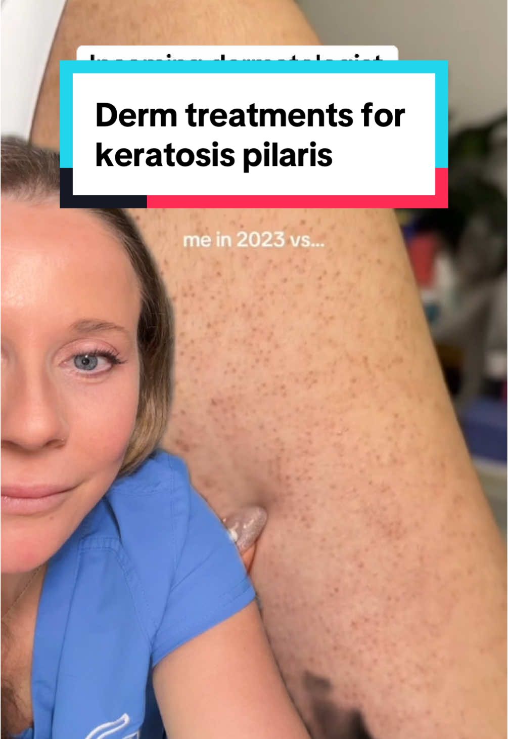 Keratosis pilaris is common and presents as small red bumps on the outer arms, bottom, thighs and cheeks. Treatment is exfoliation with a chemical exfoliant like lactic acid, glycolic acid or salicylic acid. Adding urea and a retinoid like adapaplene or tretinoin can boost the effect. Follow if you have keratosis pilaris. #stitch with  @CheekyGlo  #keratosispilaris #glycolicacid #skintok #dermatologist 