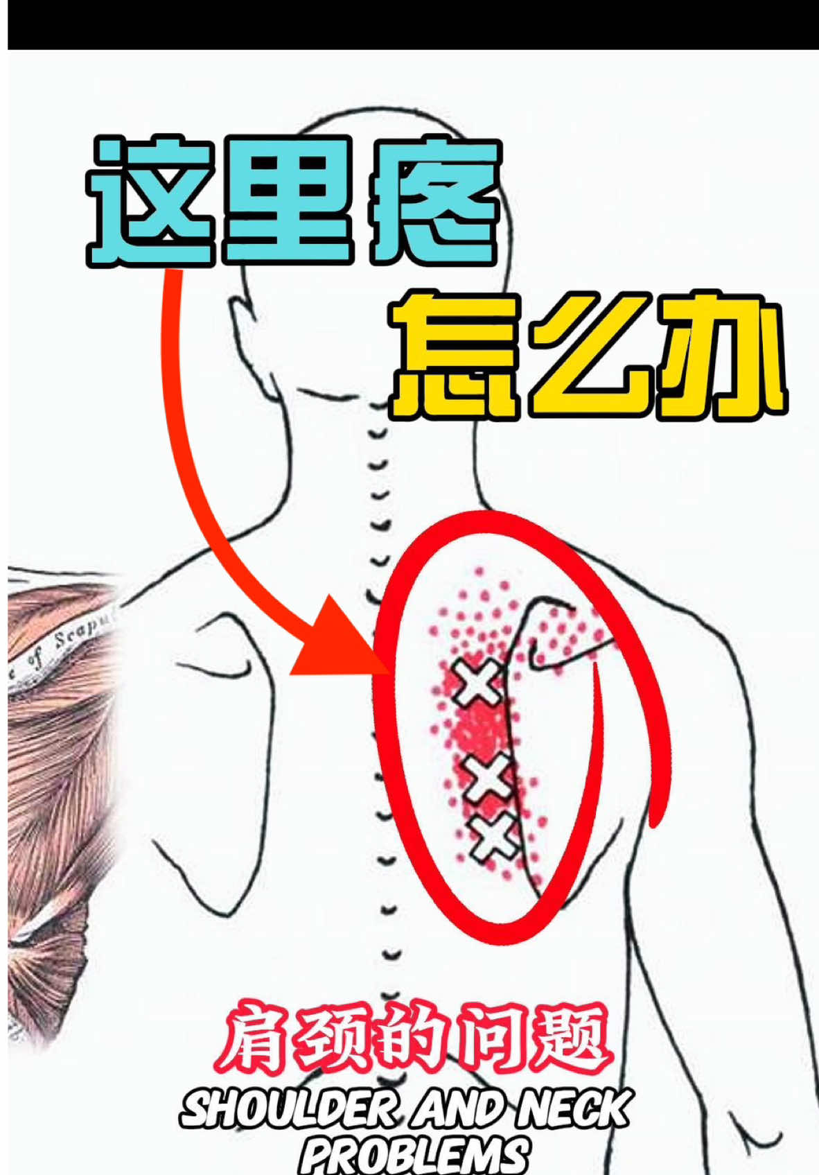 肩胛骨内侧酸痛？其实是菱形肌在作怪！一个动作快速缓解✨ 是不是肩胛骨内侧总是酸痛？ 	•	按摩也只能缓解一会儿？ 	•	感觉脖子、肩膀也有点僵硬？ 其实，真正的“罪魁祸首”不是肩颈，而是菱形肌紧张或被过度拉扯！💥 为什么会紧张？ ✅ 含胸驼背 ✅ 长时间低头、久坐 ✅ 耸肩、姿势不良 这些习惯会让菱形肌持续被拉扯或紧张，从而引发酸痛不适。 🎯【今天教你一个简单的拉伸动作，快速缓解菱形肌酸痛！】 ✅ 动作要点： 1️⃣ 将痛侧手伸直，五指朝下。 2️⃣ 对侧手压住痛侧手掌，将痛侧手缓慢拉向身体对侧。 3️⃣ 同时向下俯身，并将头转向痛侧（疼痛的一侧）。 4️⃣ 保持拉伸30秒，每侧做3组。 🎯 为什么有效？ ✅ 深层拉伸菱形肌，释放紧张感 ✅ 缓解肩胛骨内侧酸痛和僵硬 ✅ 打开背部肌群，改善含胸驼背 📌 赶紧放下手机，跟着视频试一下！做完记得告诉我你的感受吧～更多肩颈放松小技巧，记得关注我哦！ #肩胛骨酸痛 #菱形肌放松 #肩颈放松 #体态改善 #健康生活#菱形肌放松 #肩胛骨酸痛 #肩颈放松 #简单拉伸 #居家健身 #肩颈健康 #背部放松 #姿势矫正 #含胸驼背改善 #身体灵活性 #疼痛缓解 #运动康复 #健康生活 #健身小贴士 #肩胛骨健康#RhomboidRelease #ShoulderBladePain #NeckShoulderRelief #SimpleStretch #HomeWorkout #PostureCorrection #BackPainRelief #ChestOpener #BodyFlexibility #PainReliefTips #PhysicalTherapy #HealthyLifestyle #FitnessTips #PainManagement #HealthTips