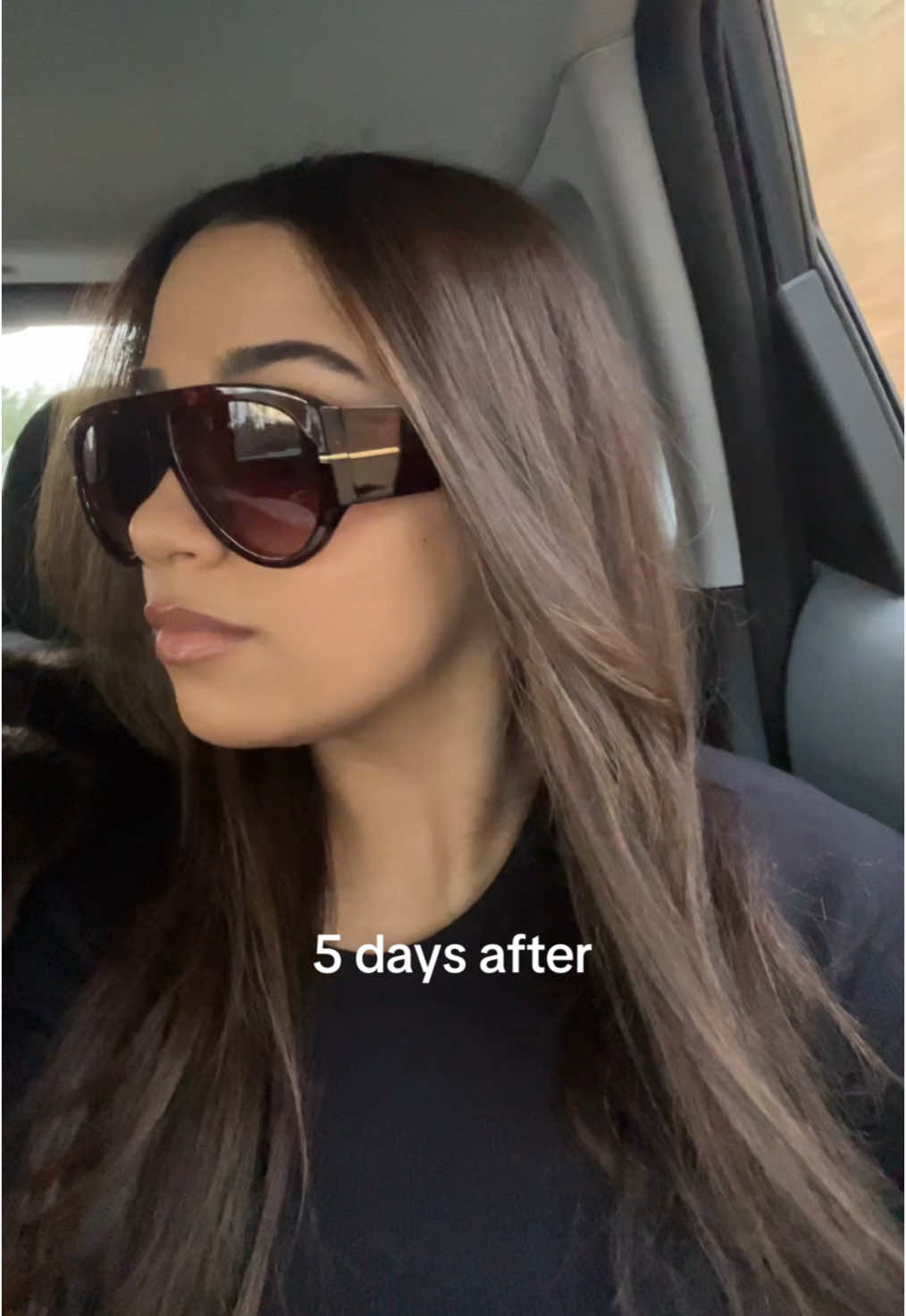 masseter botox… facial slimming and no pain in just 2 weeks💕 #botox #jawline #medspa #masseterbotox #tmj #fy 