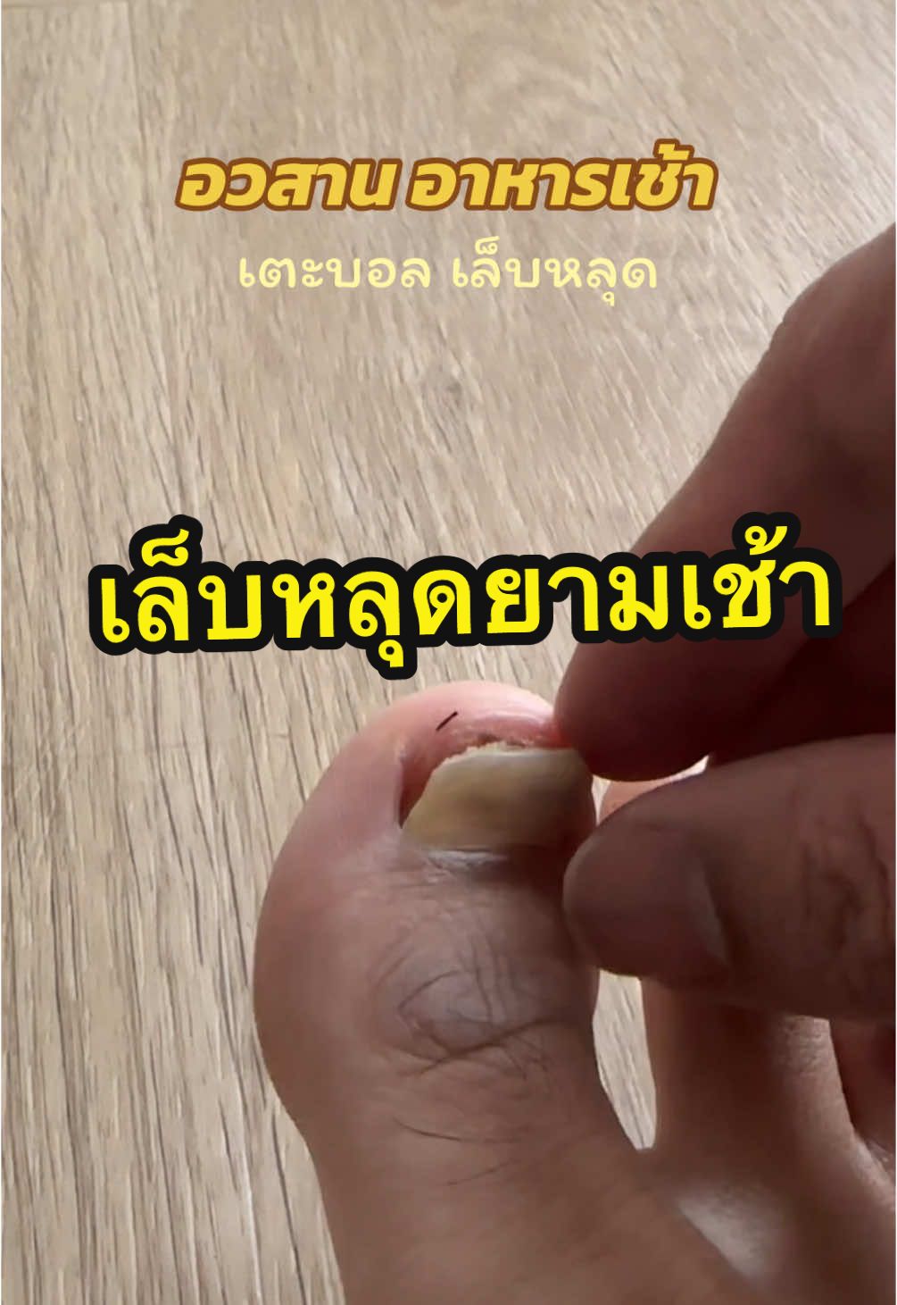 เตะบอลบ่อย ใครเป็นบ้าง #เล็บหลุด #เล็บขบ #เตะบอล #kboss 