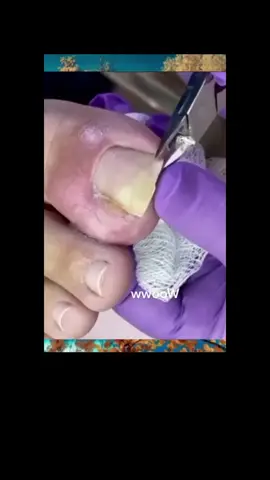 #toenails #ingrowntoenail #toenailremoval #nails #toenail #satisfyingvideo #fyp