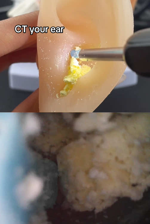 how ear spoons work? #medicalhumor #earspoons#eardisease #earwork #workofear#eartechnique #eardrum  At such a low price these are sellingfast i ditched the ear buds andreplaced it with this ear pick toremove the wax jnstead  #ear#earwax #earwaxremoval#earwaxcleaning#hygine #clean #earwaxremmova#barqain #tiktokmademebuvit#blackfriday Ear spoons that can see everything  #fyp #otoscope #visualearpicking #earcleaning#earcleaningvideos#otoscopecamera #earpickingspoon#earwaxcleaning I didn't know how to effectivelyremove dirt from my ears becausethey were seriously affecting myhearing until l got this stuff An earspoon with a camera for less than 15dollars.#EarWaxCleaner#AffordableTech#RechargeableCleaner#SafeEarCleaning#aift#tiktokshopblackfriday#tiktokshopcybermonday EAR WAX REMOVAL TOOL!!! Get your hearing BACK TO HOW:ITWAS! With a simple tool that has aspoon to get to those HARD TOREACH areas! Even a camera toPRECISELY REMOVE all that GUNk!! #earwaxremoval #earcleaningtoo#hearingloss #earcleaning#tiktokgadgets