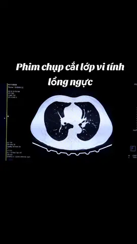 Phim CT (Cắt lớp vi tính) lồng ngực. 