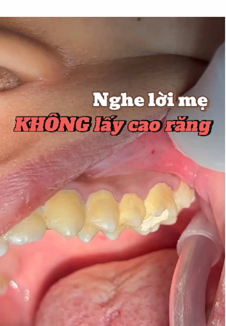 🥹🥹 Nghe lời mẹ không lấy cao răng và cái kết…  #niengrangmaccai #niềng_răng #nhasihoangthao #rangmieng 