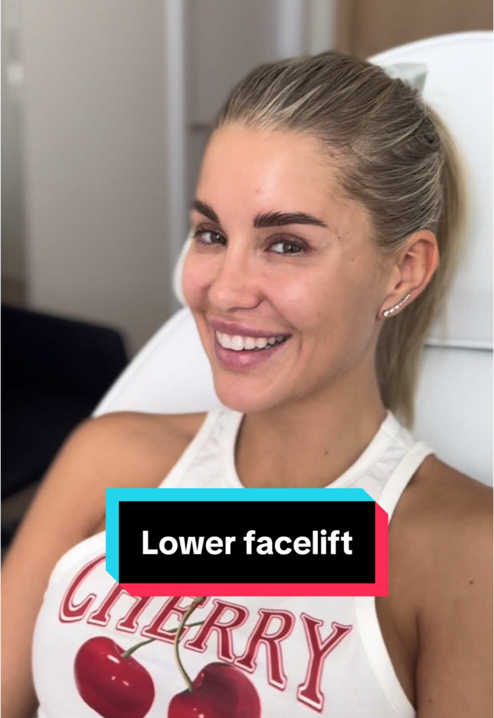 Results 6 weeks after lower facelift👌 Done under local anesthesia😊 📲 If you want to make an appointment, contact us at contact@v-clinic.cz #lowerfacelift #plasticsurgery #plasticsurgeon #plastickachirurgie #ventruba #vclinic #transformation #beforeandafter