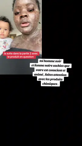 homme noir et femme noire faite attention avec les produits chimiques que vous mettez sur votre corps #produitchimique #depigmentation #brûlure #produitsnaturels #corps #peau #videoviral #afriquetiktok #produitbeauté  #