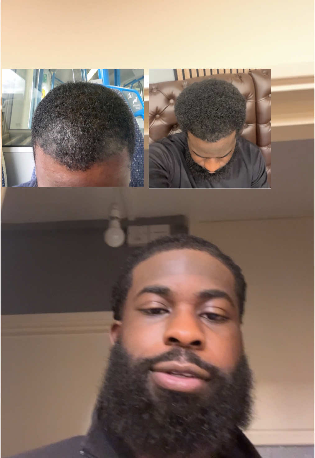 My explanation 🫢 #hairtransformation #thinninghair #hairloss #fyp #hairgrowth #afrohair #hairlosssolutions #hairlossjourney #blackmen 