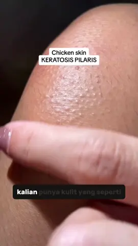 chicken skin keratosis pilaris