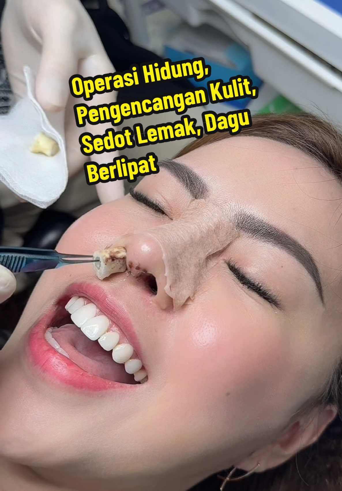 Operasi Hidung, Pengencangan Kulit, Sedot Lemak, Dagu Berlipat##goretes#nosejob#manila#philipines #jakarta#jakartatravel #hidung#thailand#indonesia#eyelidsurgery 